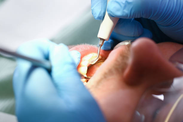 Best Emergency Dentist for Knocked-Out Tooth in Wilson, PA