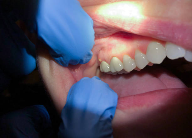 Best Emergency Dental Extractions in Wilson, PA